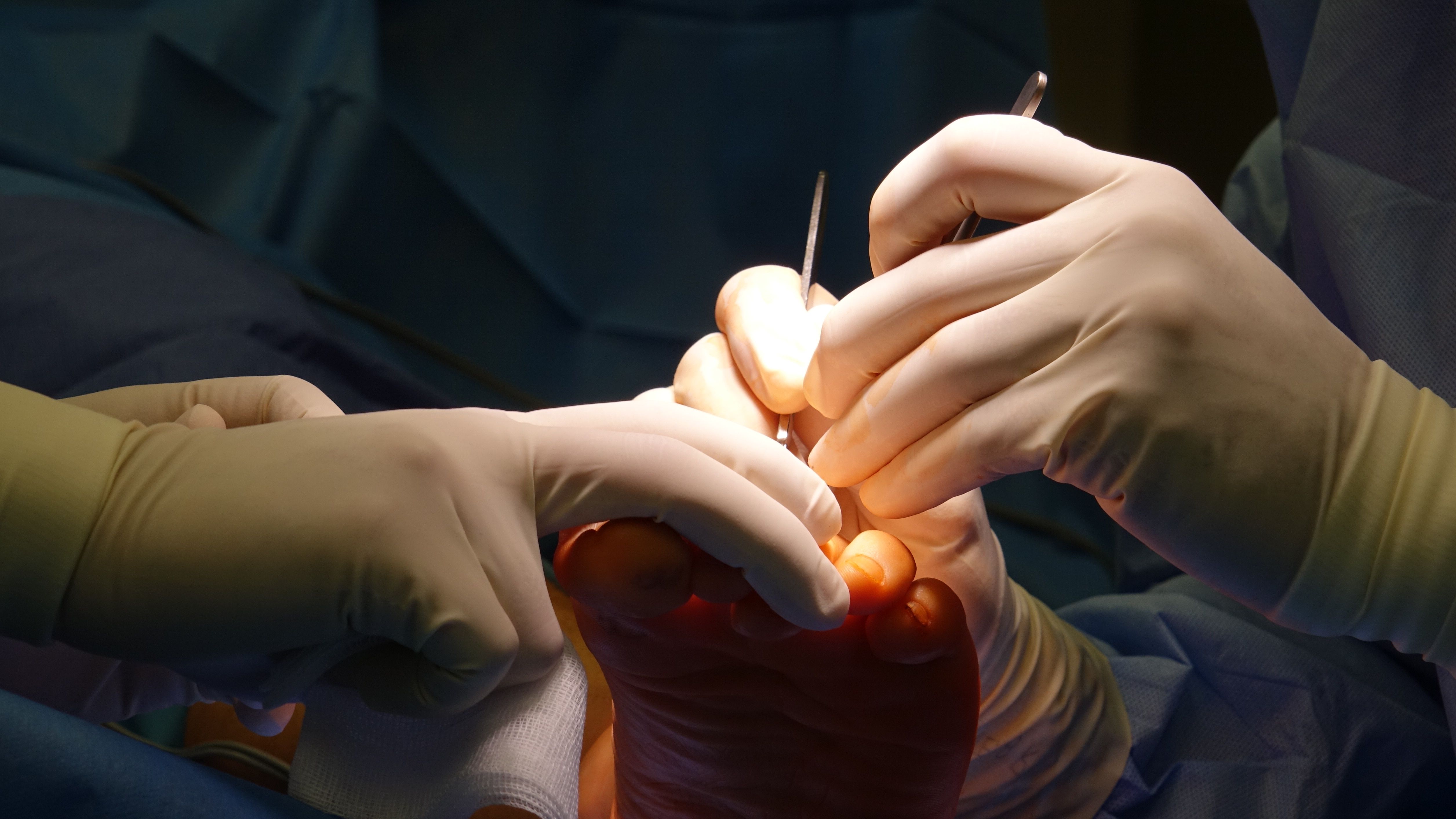 Neuroma foot pain